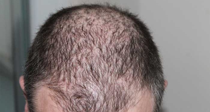Does Laser Therapy Really Work for Hair Loss?